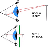Normal Sight: Normal ray tracing of light to the retina. Shows image will 'flip'.

With Pinhole: Ray tracing of pin through pinhole; a shadow is cast on the retina.